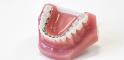 Kfo wolbeck innenliegende brackets